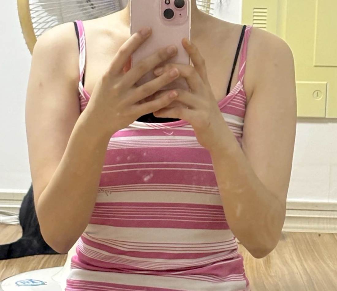 Before arm liposuction of Jeoyoi in Korea—pink striped tank top, upper arms look full and round.