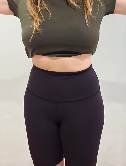 After photo of jesscoco showing defined abs and slimmer figure following abdominal liposuction in Korea