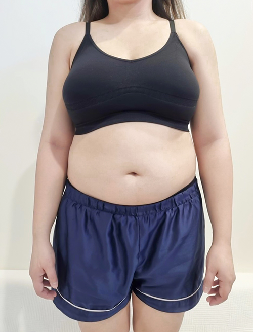 Before photo of jesscoco showing abdominal fat prior to liposuction surgery at Lesarts Plastic Surgery in Korea