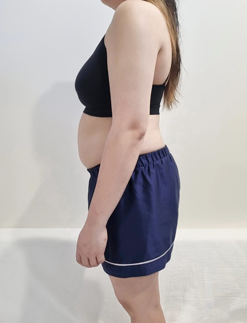 Side view before photo of jesscoco with visible lower belly fat before abdominal liposuction in Korea