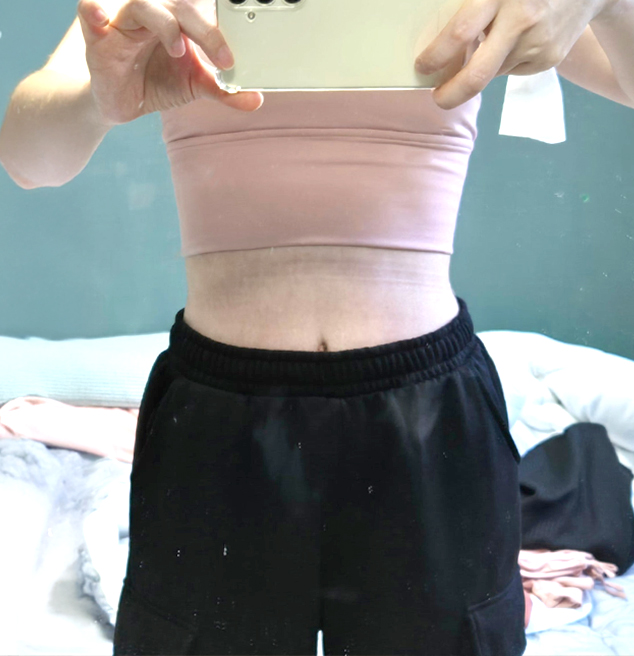 After tummy tuck of Jingjingssi in Korea—wearing high-waist black pants, midsection appears tightened.