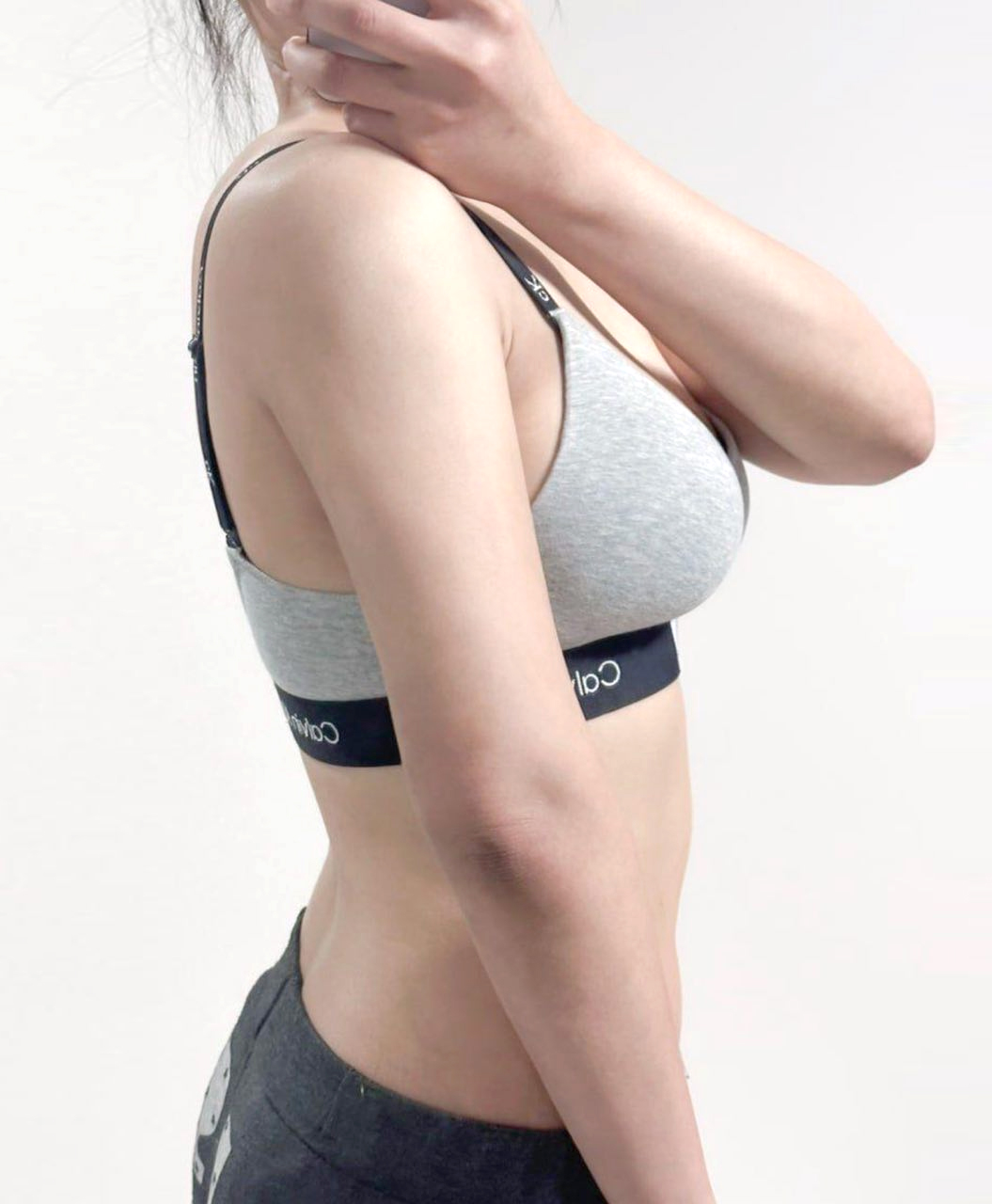 After arm liposuction of Jorollo in Korea—side view in gray bra, smoother and slimmer upper arm.