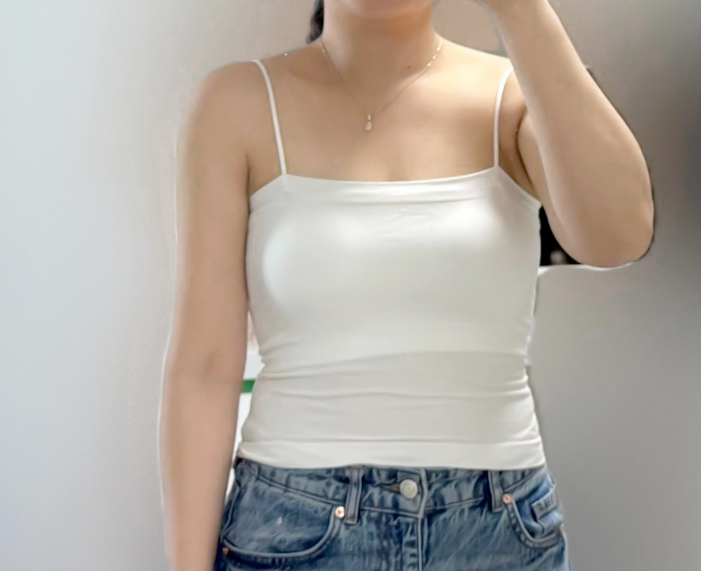 Slimmer arm contour after 3 months of arm liposuction recovery by Kyokyokyo in Korea