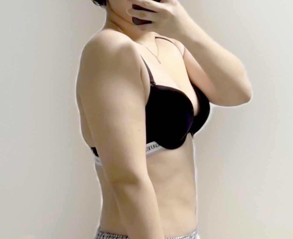 Visible upper arm fat before fat removal procedure at Lesarts in Korea