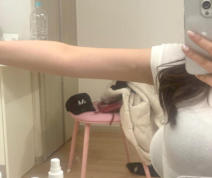 Post-liposuction result showing Lucia00’s smooth underarm and shoulder contour after fat removal.