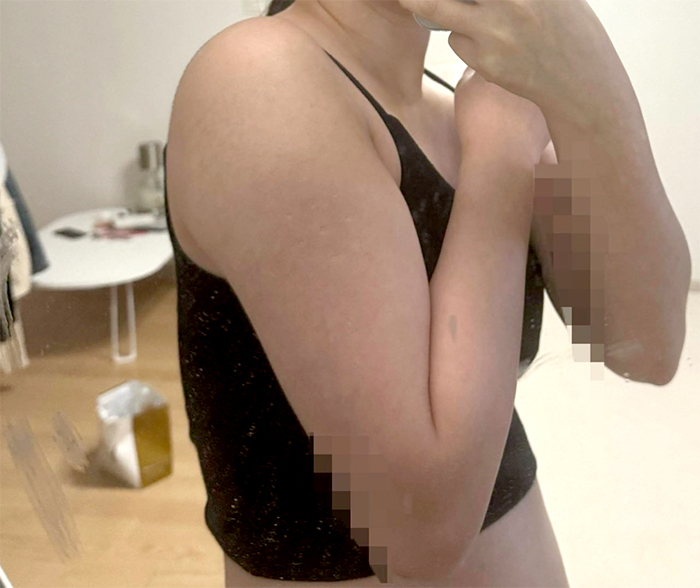 Pre-op image of Lucia00 before underarm and scapula fat removal surgery at Lesarts in Korea.