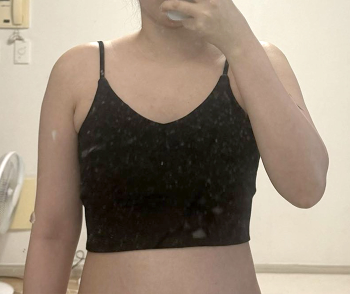 Lucia00 before arm liposuction in Korea, showing visible upper arm and underarm fat.