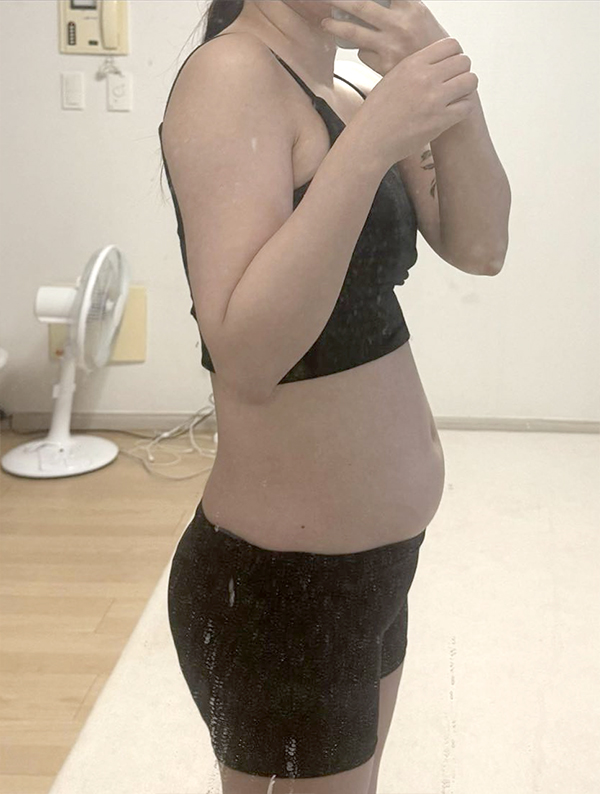 Before abdominal and hip fat transfer of Lucia00 in Korea—side view in black outfit, prominent love handles.