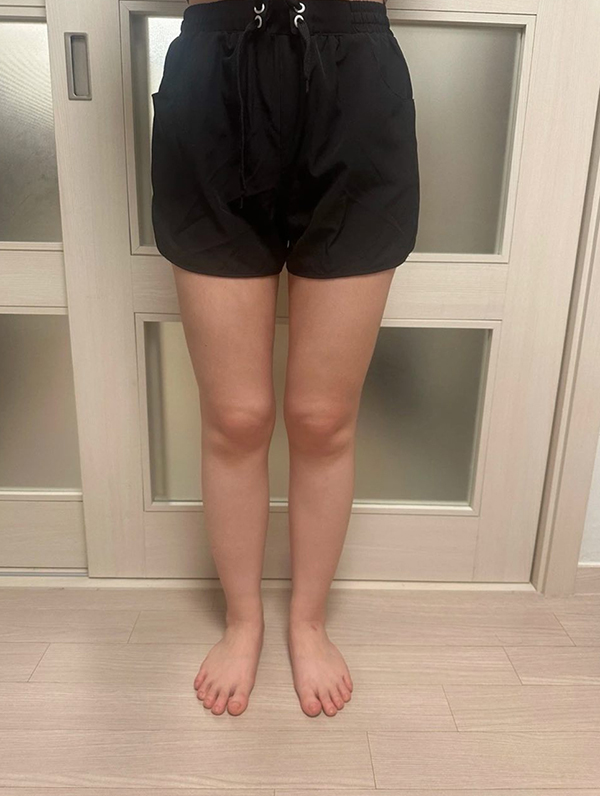 After thigh liposuction of Manimaniyong in Korea—front view in black shorts, inner thigh gap and balanced shape visible.