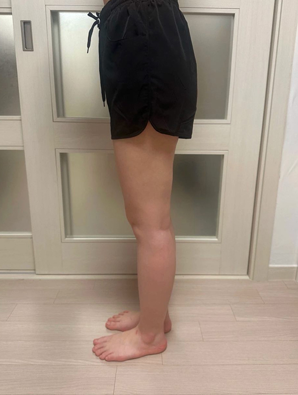 After thigh liposuction of Manimaniyong in Korea—side view, slim leg line and natural silhouette with no bulge.