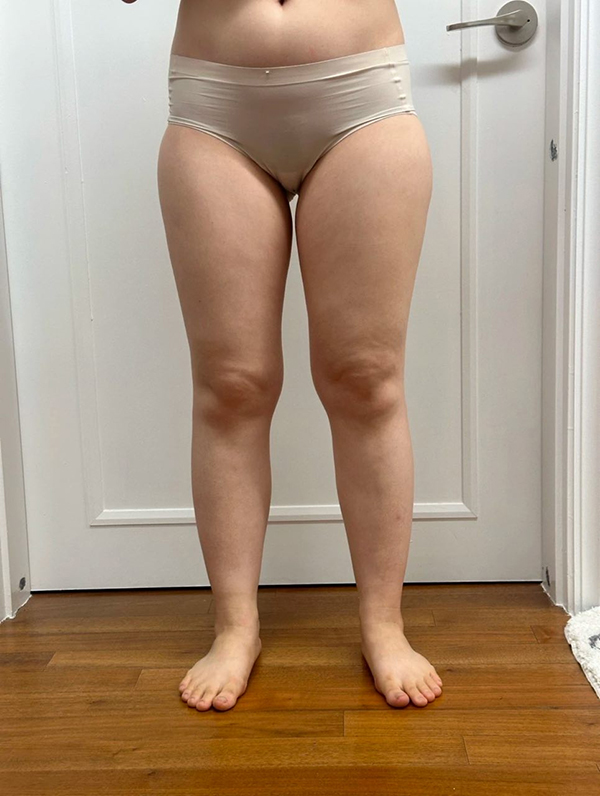 Before thigh liposuction of Manimaniyong in Korea—front view, thighs touching and overall volume prominent.
