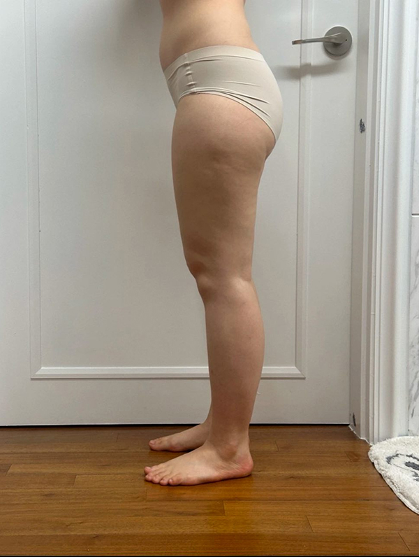 Before thigh liposuction of Manimaniyong in Korea—side view, outer thigh protrusion and full back silhouette.