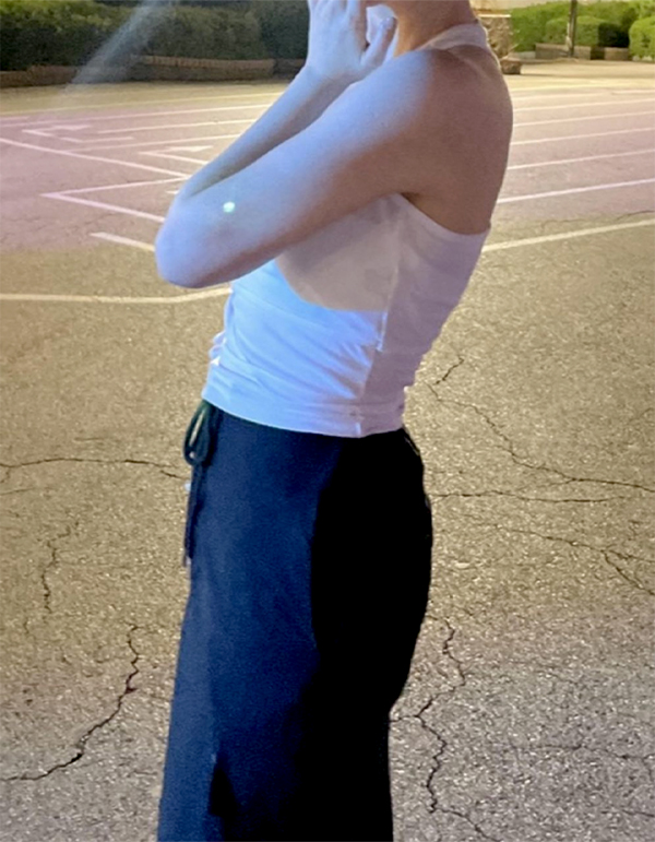 After arm liposuction photo of Nadouippeojillae2, 5 months post-op with slim arms at Lesarts in Seoul.