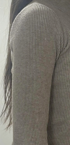 Natural arm shape in fitted sleeves after fat removal surgery