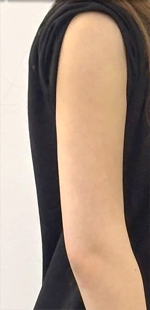Slimmer arm contour after arm liposuction by Ningning at Lesarts Plastic Surgery in Korea