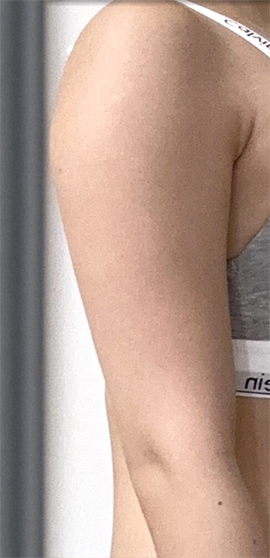 Close-up view of upper arms before arm liposuction by Ningning at Lesarts Plastic Surgery