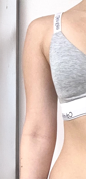 Visible arm thickness before surgery at Lesarts in Korea