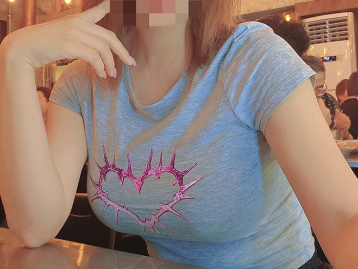 2-month post-op result photo of NyangiHNPq9 after arm liposuction, arms appear noticeably slimmer and firmer at Lesarts.