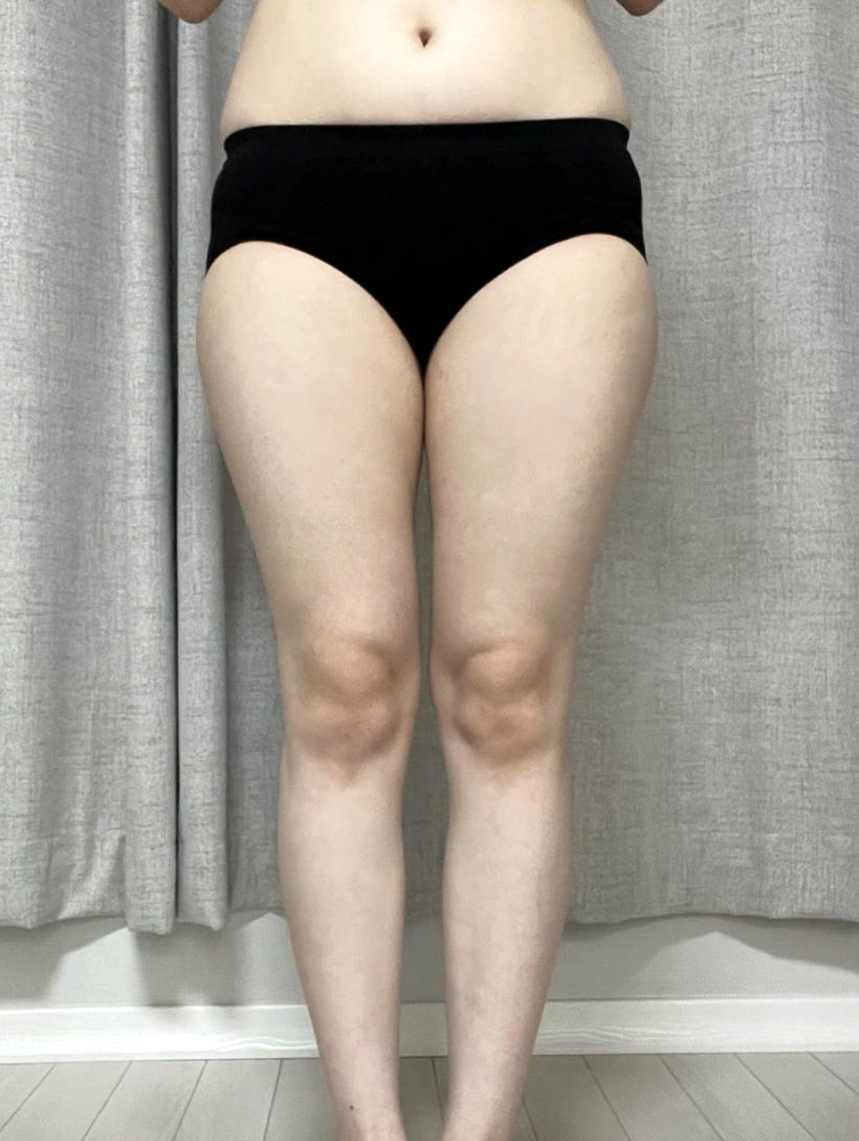 Thigh liposuction hip line NyangiQesco