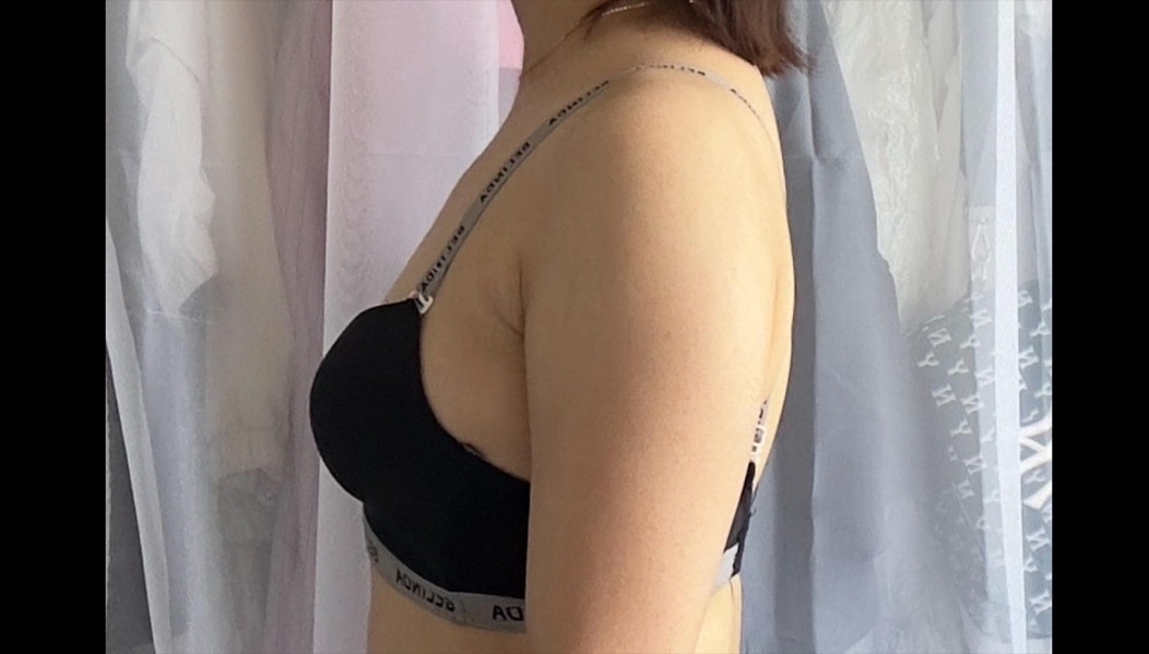 Before arm liposuction of Nyangiq4BuF in Korea—side view in black bra, showing bulky upper arm and shoulder.