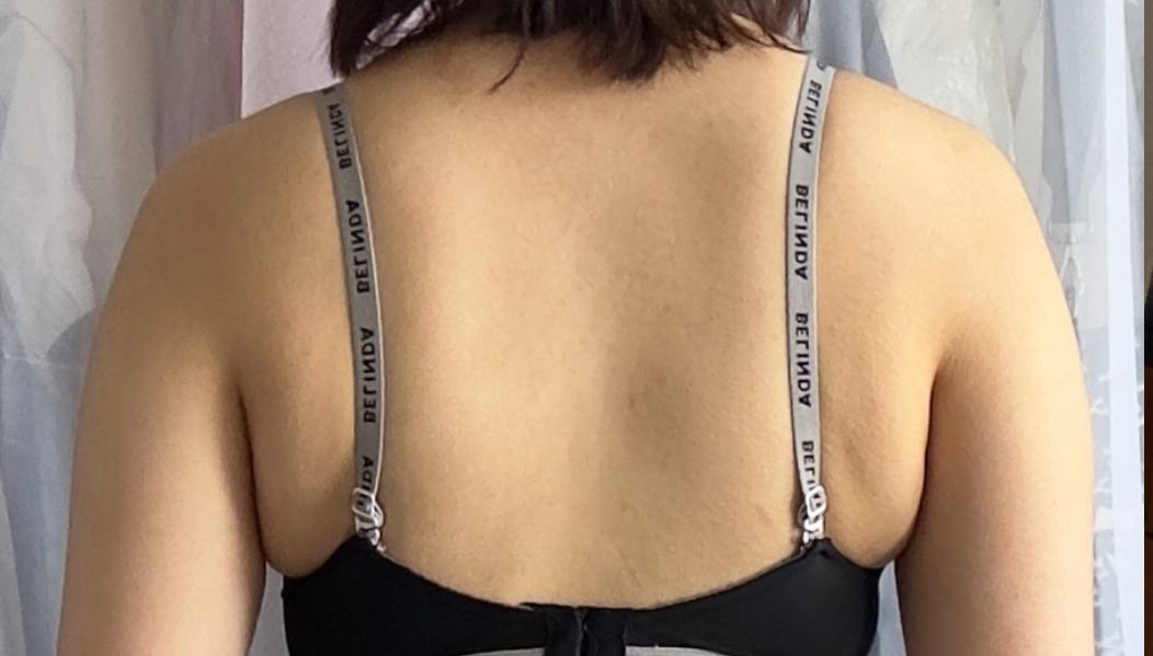 Before arm liposuction of Nyangiq4BuF in Korea—back view in black bra, visible bra bulge and upper arm fat.
