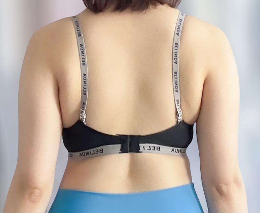 Back view before arm liposuction in Korea—visible fat around arms in bra strap area.