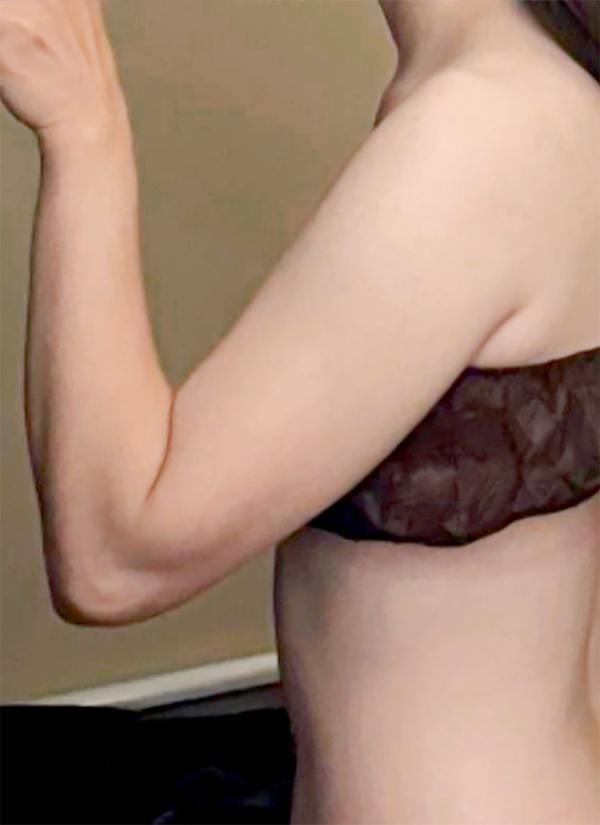 Before arm liposuction of Santamarianobellam in Korea—side view in brown bra, visible upper arm thickness.