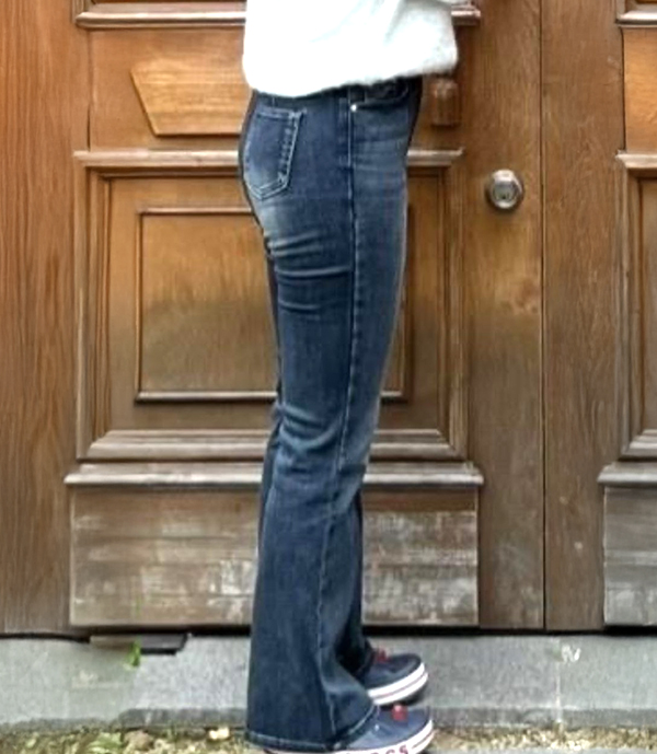 After thigh liposuction of Tokkifwj2M in Korea—wearing fitted jeans, legs appear straighter and slimmer.
