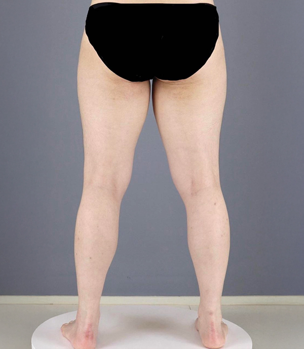 Before thigh liposuction of Tokkifwj2M in Korea—back view, no visible gap and bulky inner thighs.