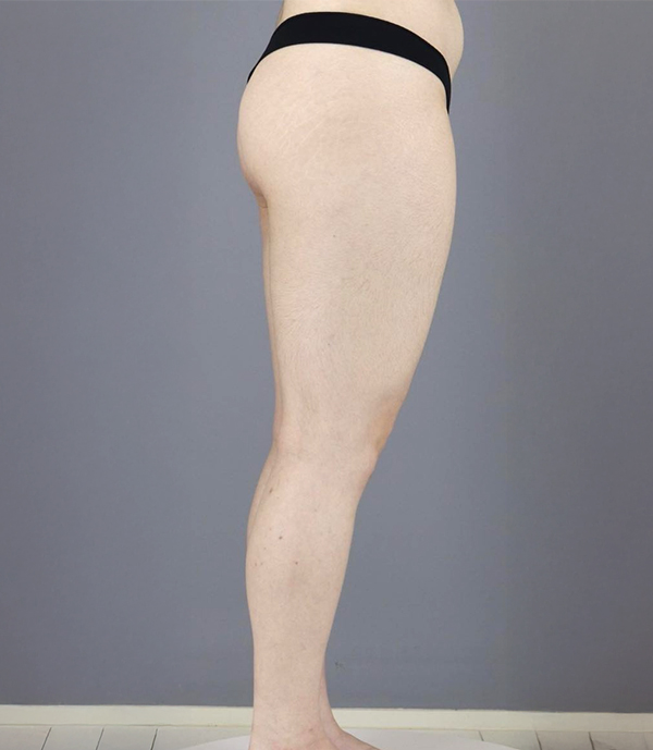Before thigh liposuction of Tokkifwj2M in Korea—side view with thick thighs and undefined contour.