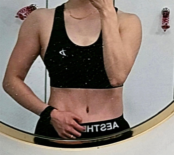 After tummy tuck of UnniAoPoNX in Korea—black bikini outfit shows tightened belly and defined waist.