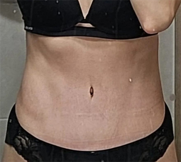 After tummy tuck of UnniAoPoNX in Korea—wearing black sports bra, stomach is flat and scar is fading.