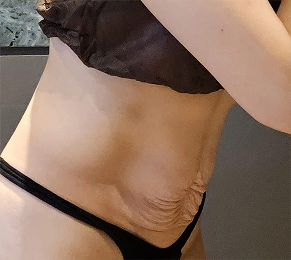 Before tummy tuck and liposuction of UnniAoPoNX in Korea—side view, loose lower abdomen and skin fold visible.
