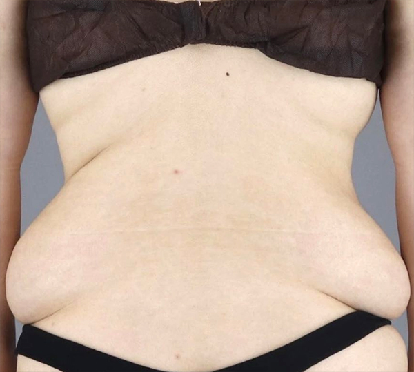 Before photo of Yeonikkot showing sagging love handles before liposuction at Lesarts in Korea.