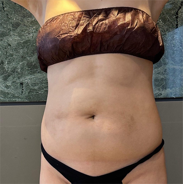 Before abdominal liposuction and buttocks fat transfer of YeouGqqxu in Korea—side view, abdominal protrusion and undefined hip line.