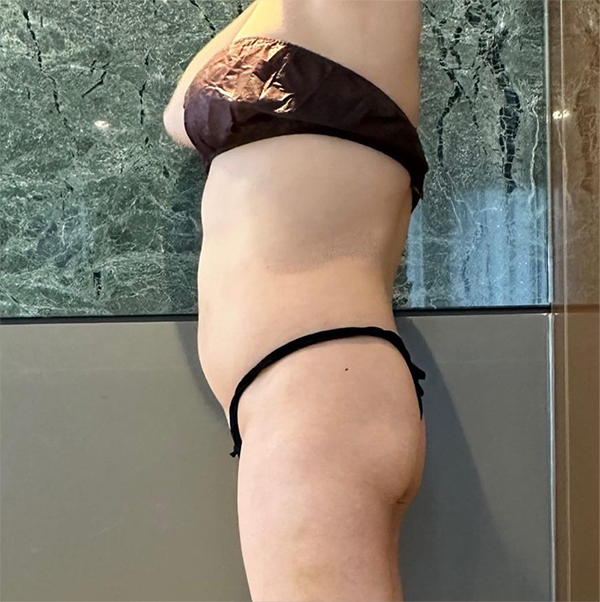 Before abdominal liposuction and buttocks fat transfer of YeouGqqxu in Korea—front view, visible belly fat and flat hips.
