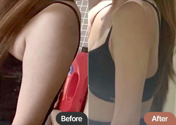 abdominal-liposuction-thumbnail-Daebeomhan