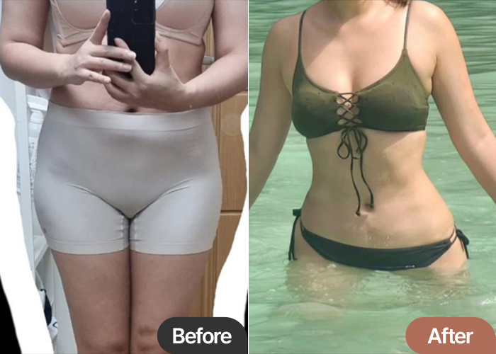 Before and after thigh and abdominal liposuction of Gangnam1deung in Korea—dramatic improvement in belly and leg contour.