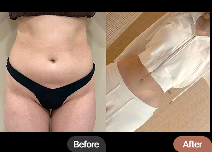 Before and after abdominal liposuction and hip fat transfer of Hari in Korea—dramatic waistline improvement and balanced hip curve.