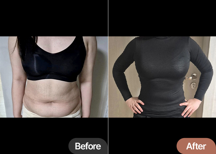 Before and after liposuction of Hihehohihe in Korea—visible reduction in belly and arm fat with improved body line.