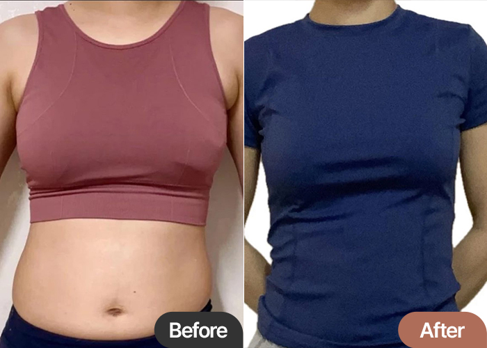 Before and after comparison of arm and abdominal liposuction by Janzanjjanjjan at Lesarts Plastic Surgery in Korea