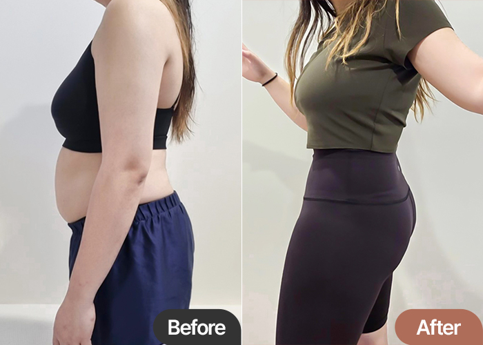 Before and after comparison of jesscoco showing dramatic change in waist and belly line after abdominal liposuction in Korea