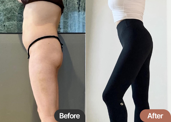 abdominal-liposuction-thumbnail-Jjeong2yong