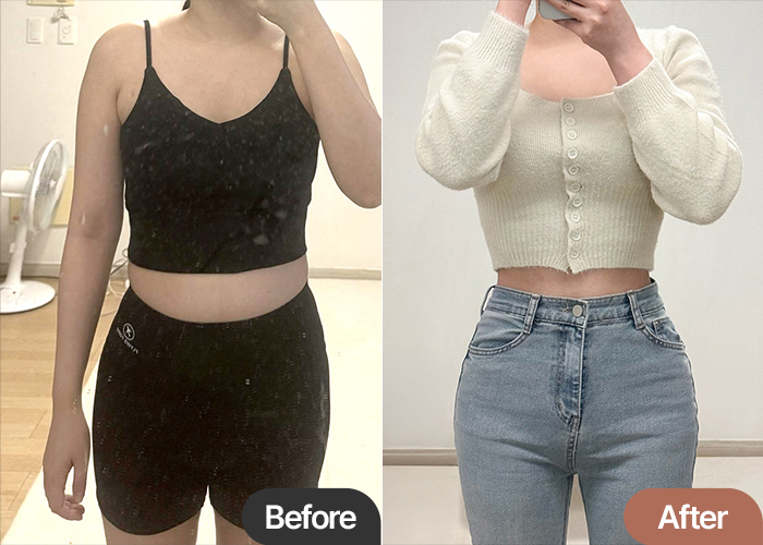 Before and after liposuction and fat transfer of Lucia00 in Korea—dramatic improvement in belly, waist, and hip balance.