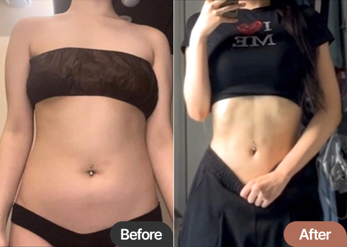 abdominal-liposuction-thumbnail-Maemyema