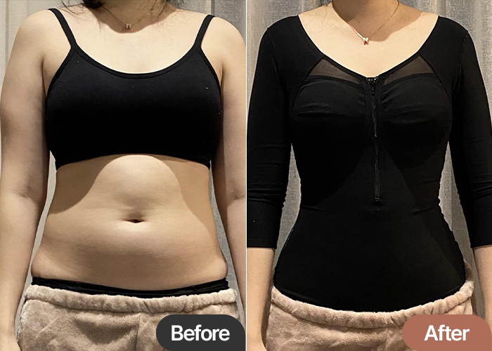 abdominal-liposuction-thumbnail-Nyanginyangi