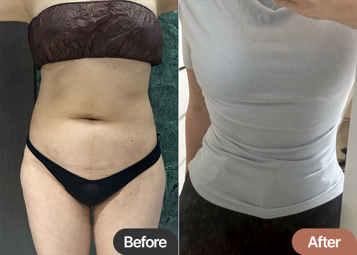 abdominal-liposuction-thumbnail-Pyeongsaengdiet