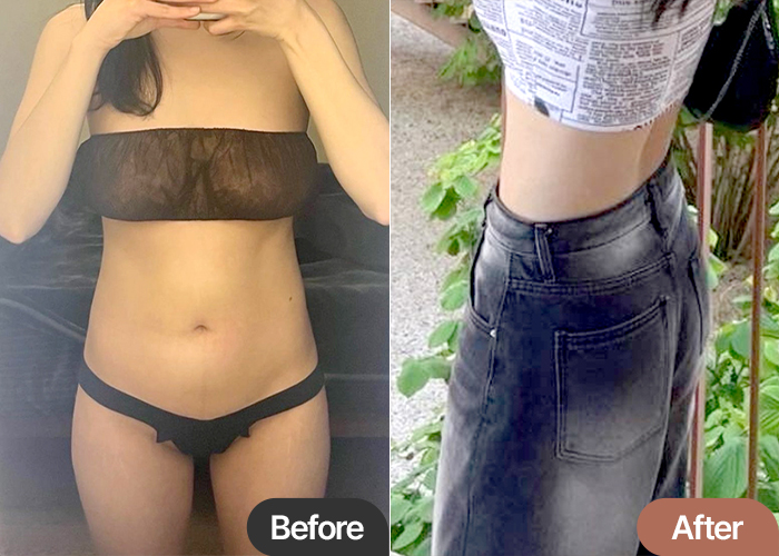 abdominal-liposuction-thumbnail-Rapunjel
