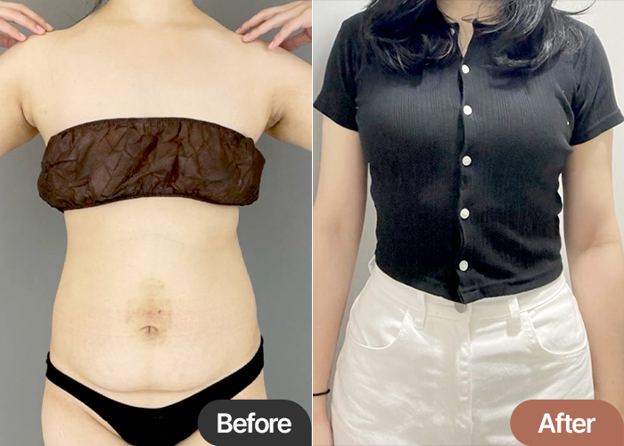 tummy-tuck-thumbnail-Ssoya2