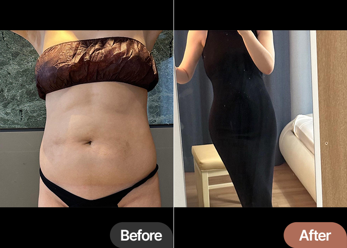 Before and after abdominal liposuction and buttocks fat transfer of YeouGqqxu in Korea—dramatic contrast in bodyline and outfit fit.